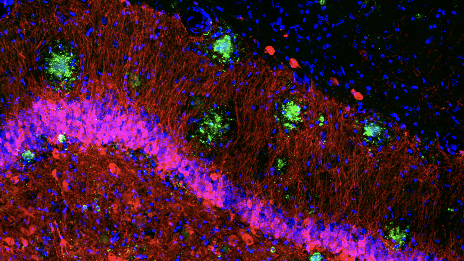 A hippocampal tissue section from Alzheimer's model in mouse showing amyloid plaques in green, surrounded by red neurons derived from experimentally activated neural stem cells, and blue-stained nuclear structures. From Kizil Lab, CUIMC.