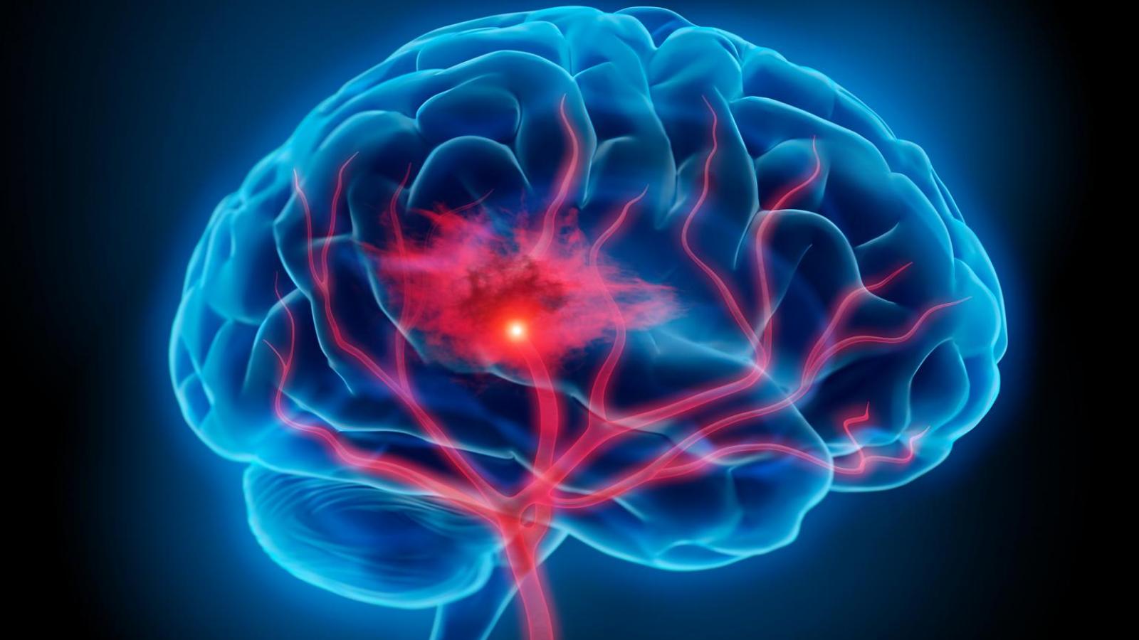 Stroke & Cerebrovascular Disease Research Columbia Neurology