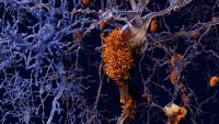 Alzheimer disease, neurons with amyloid plaques