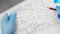 A neurologist examines an encephalogram of a patient’s brain