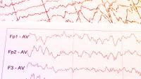 Brain wave patterns on electroencephalogram, EEG.