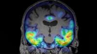 PET scan image of human brain