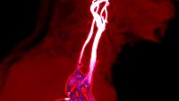 Getty Images - 2226390116_carotid